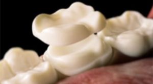 セラミックオーバーレイ