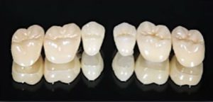 ジルコニアレイヤリング